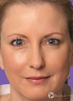 Juvederm Injection Results