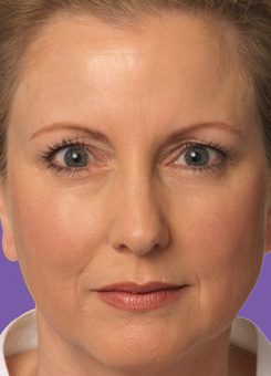 Juvederm Before After