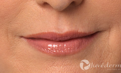 Juvederm Results
