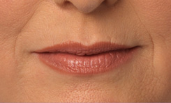 Juvederm Photos