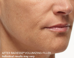 Radiesse Results