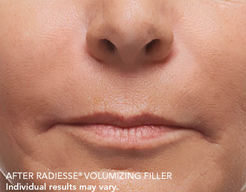 Radiesse photos