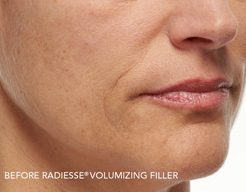 Before after Radiesse