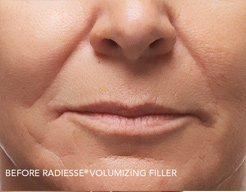 Radiesse before and after