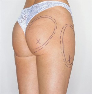 tumescent-liposuction-area fat transfer