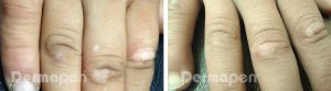 derma5