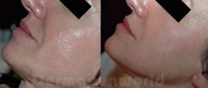 derma6