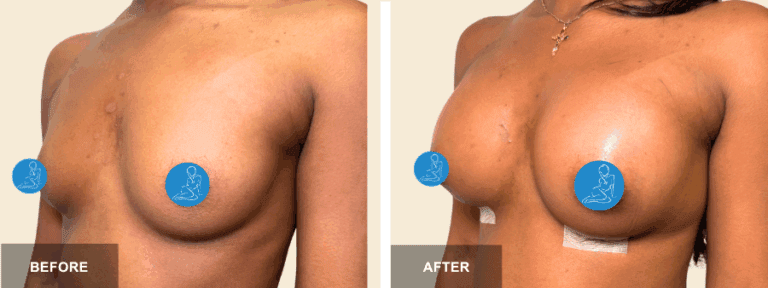 AF DRE breast aug  x