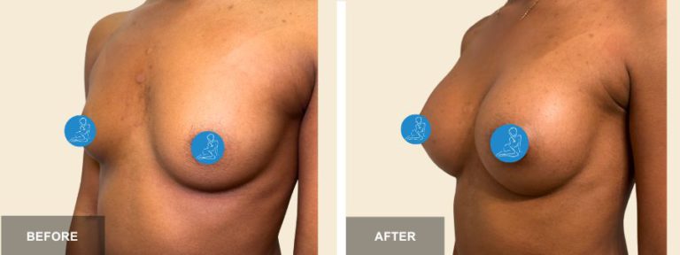 AF DRE breast aug  x