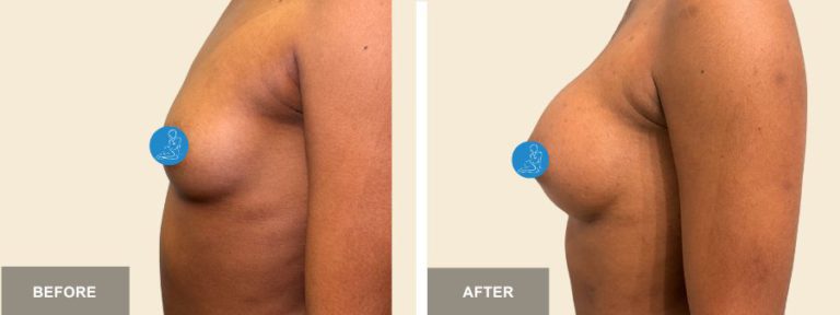 AF DRE breast aug  x