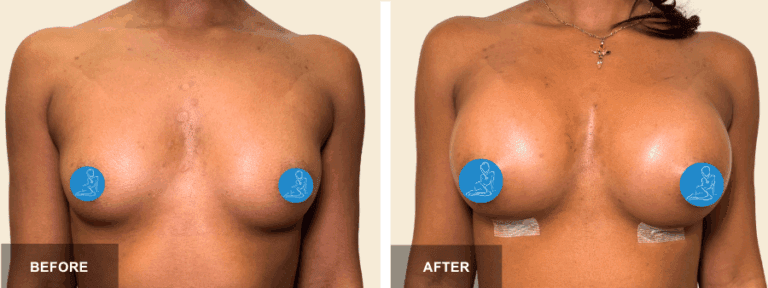AF DRE breast aug x