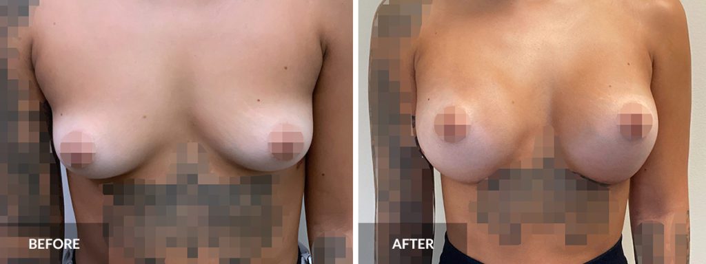Before and After Breast Augmentation Dr. Pinnella x