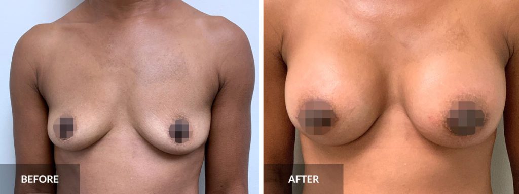Breast Aug Dr. Alexander before and after x