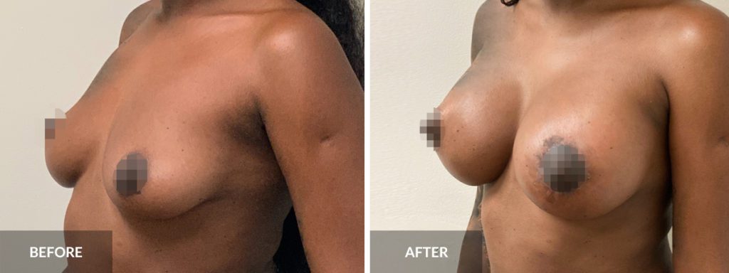 Breast Augmentation Dr. Alexander before and after x