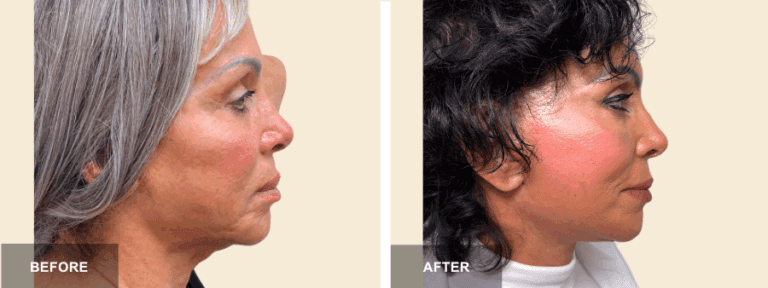 CL DRP face neck lift  x