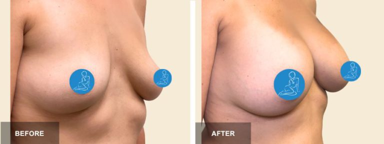 CT DRE breast aug  x