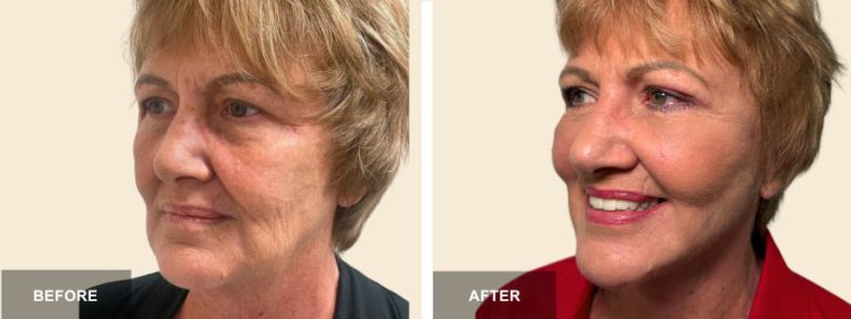 DM DRE face neck lift  x