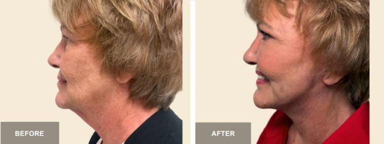 DM DRE face neck lift  x