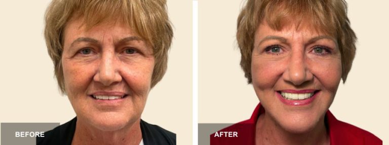 DM DRE face neck lift x