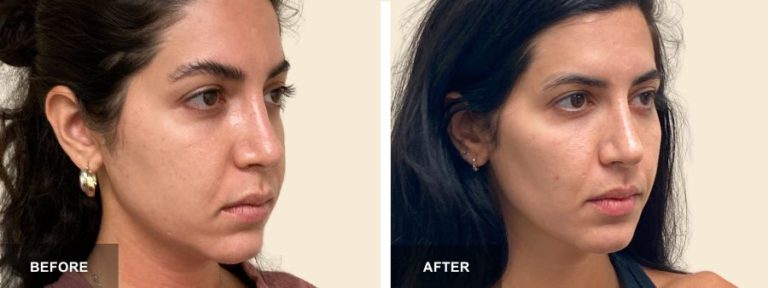 DRA Buccal fat Removal  x