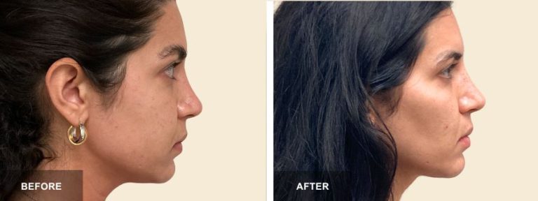 DRA Buccal fat Removal  x