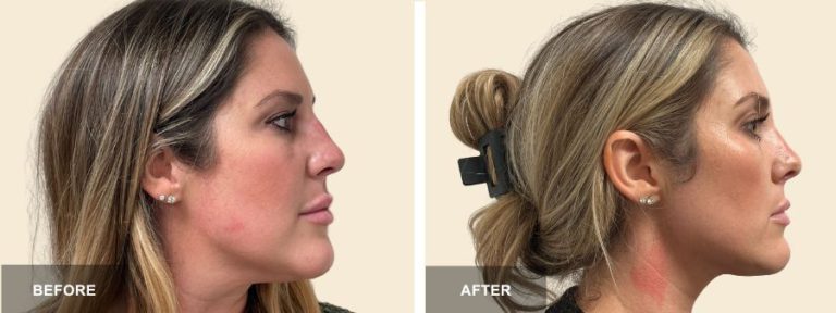 DRP Buccal fat Removal x