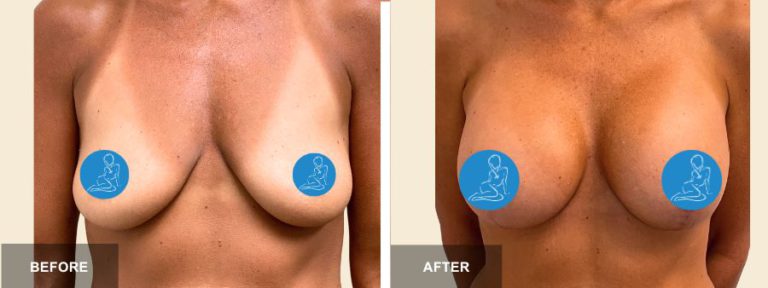 DS DRE breast aug lift  x