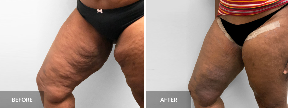 Dr. Alexander Thigh Lift before and after