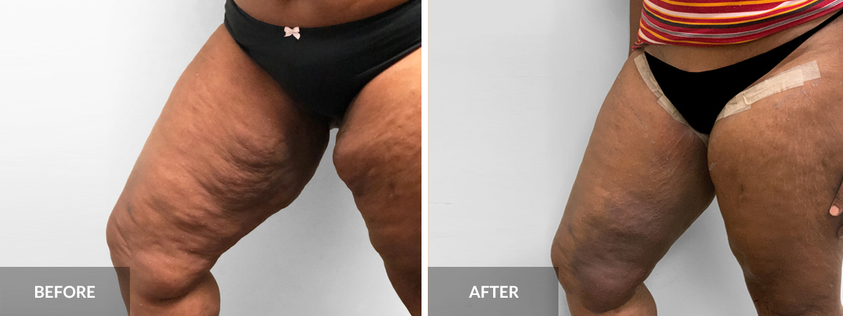 Thigh Lift Surgery  South Florida Center for Cosmetic Surgery