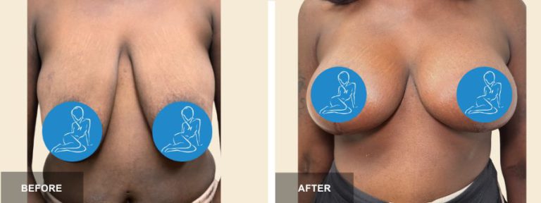 GP DRE breast lift  x