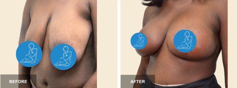 GP DRE breast lift  x