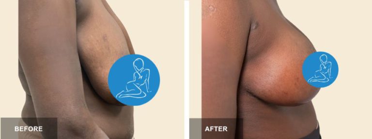 GP DRE breast lift  x