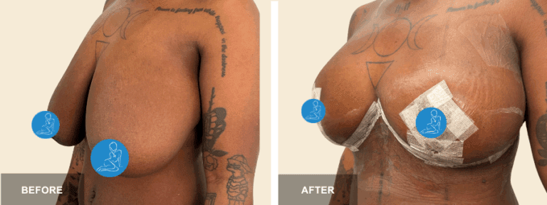 GS DRR breast reduction  x
