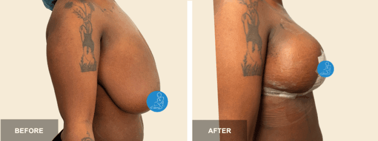 GS DRR breast reduction  x