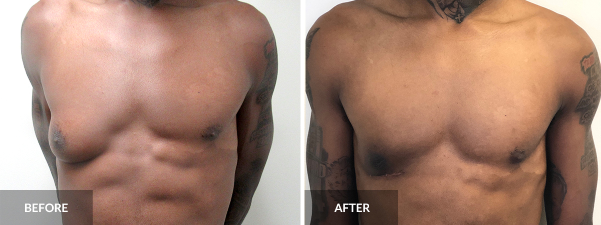 Gynecomastia Dr. Alexander Before and after