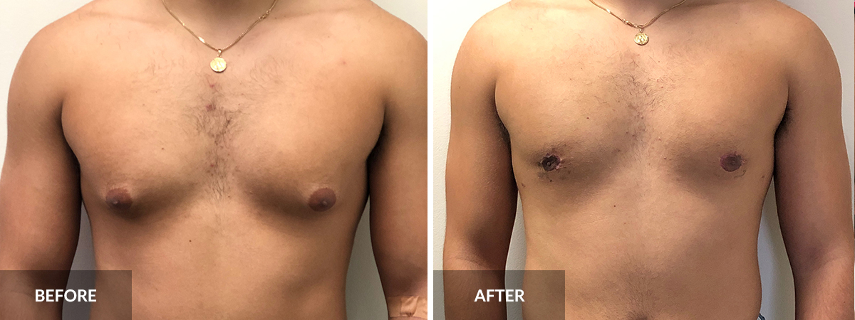 Gynecomastia Dr. Alexander before and after 