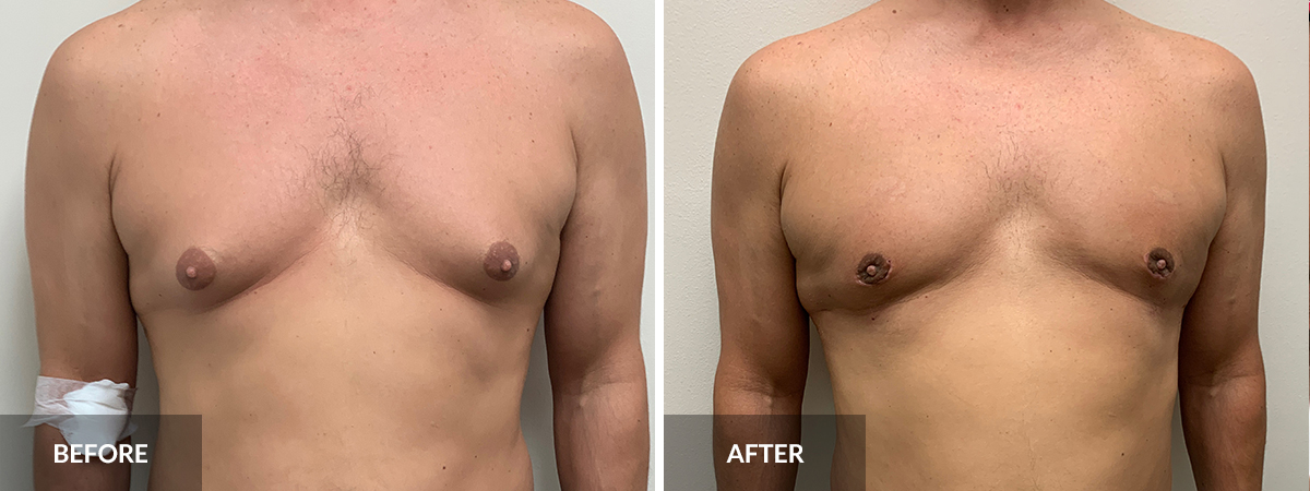 Gynecomastia Dr. Pinnella before and after 