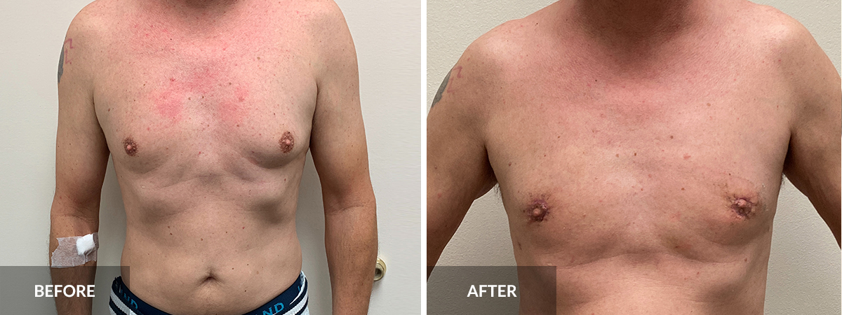Gynecomastia before and after Dr.Alexander