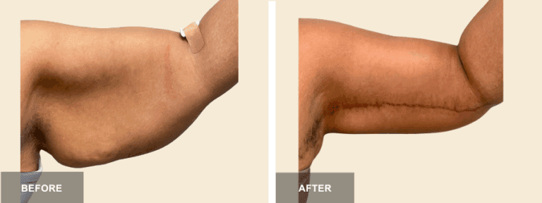 JM DRE brachioplasty  x
