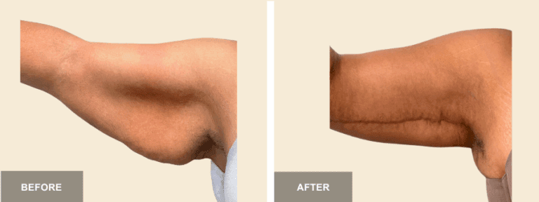 JM DRE brachioplasty x