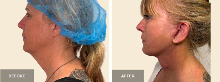 JR DRR face neck lift  x