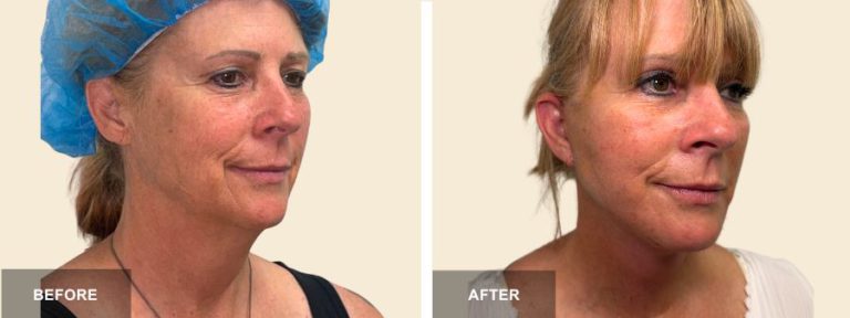 JR DRR face neck lift x