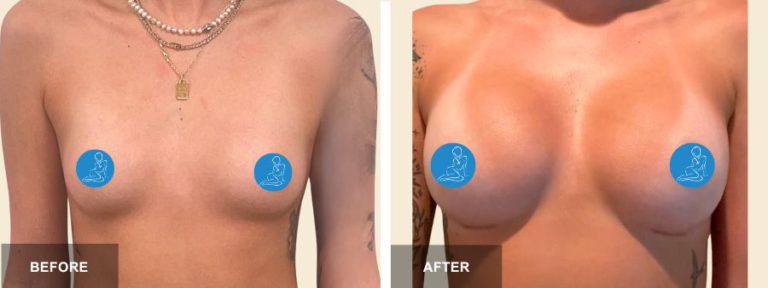 KH DRE breast aug  x
