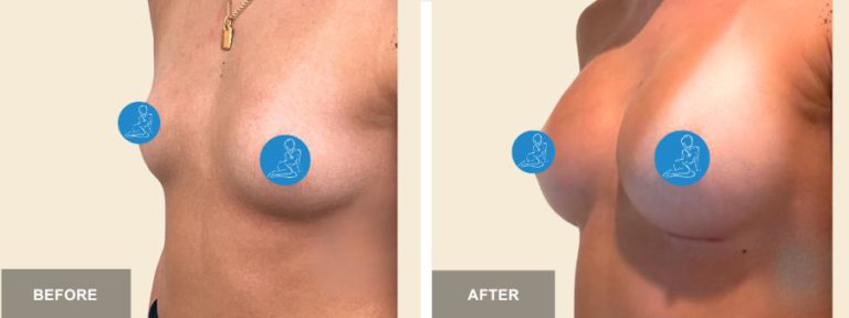 KH DRE breast aug  x