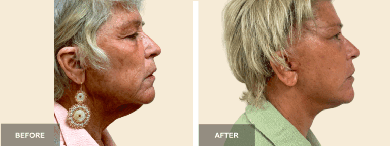 KJM DRP mid face neck lift  x