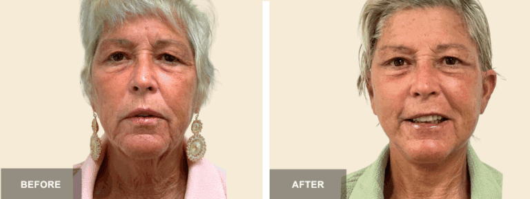 KJM DRP mid face neck lift x