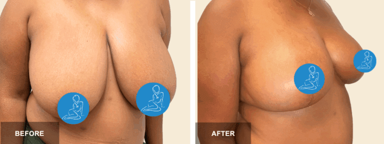 LA DRR breast reduction  x