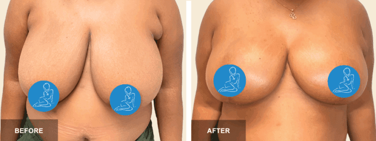 LA DRR breast reduction x