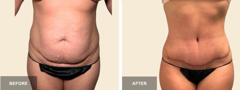 LB DRE tummy tuck x