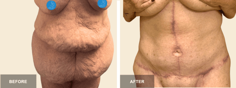 LC DRE beltectomy fluer de lis tt x